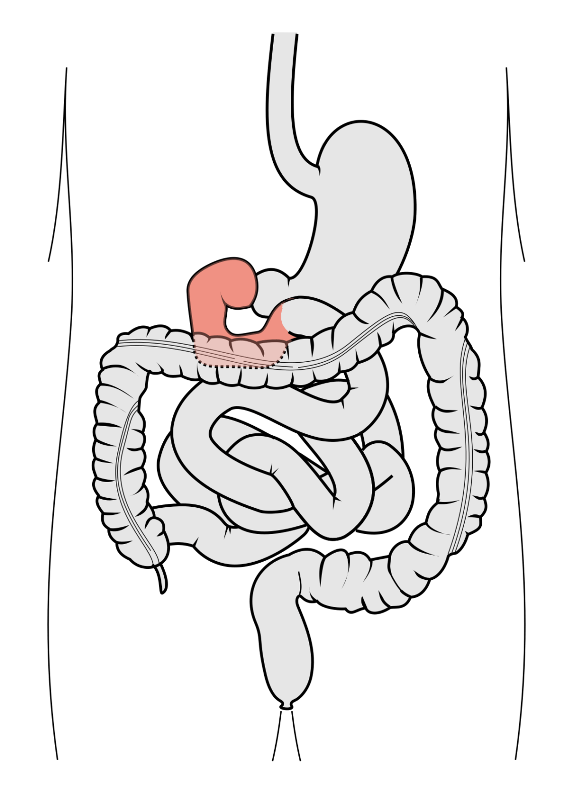 intestinale duodeno