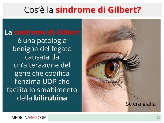 Sindrome di Gilbert iperbilirubinemia – cosa fare