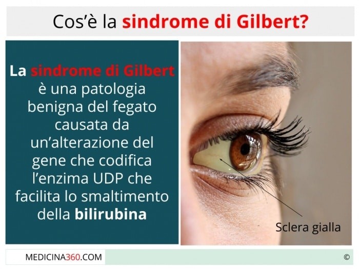 sindrome di