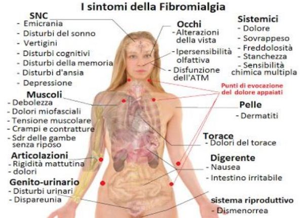fibromialgia SINTOMI