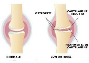 artrosi ginocchio